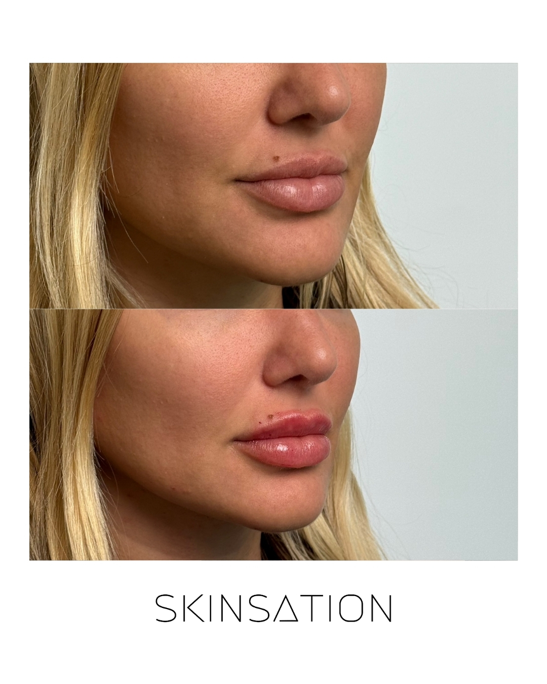 Injectable before and after result 25