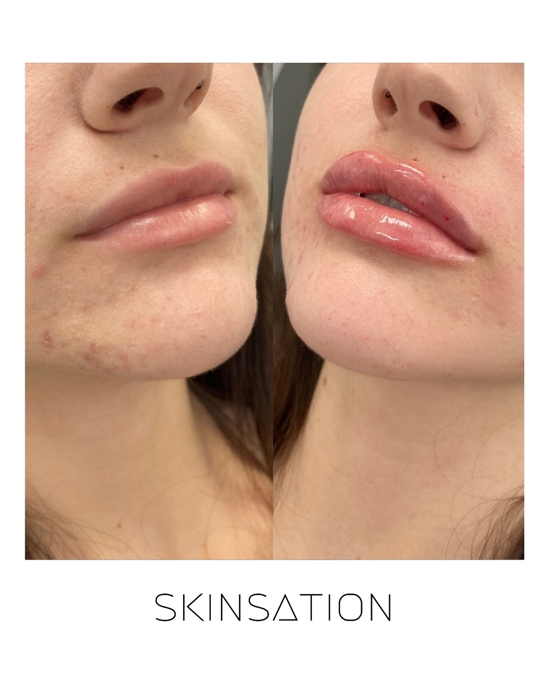 Injectable before and after result 26