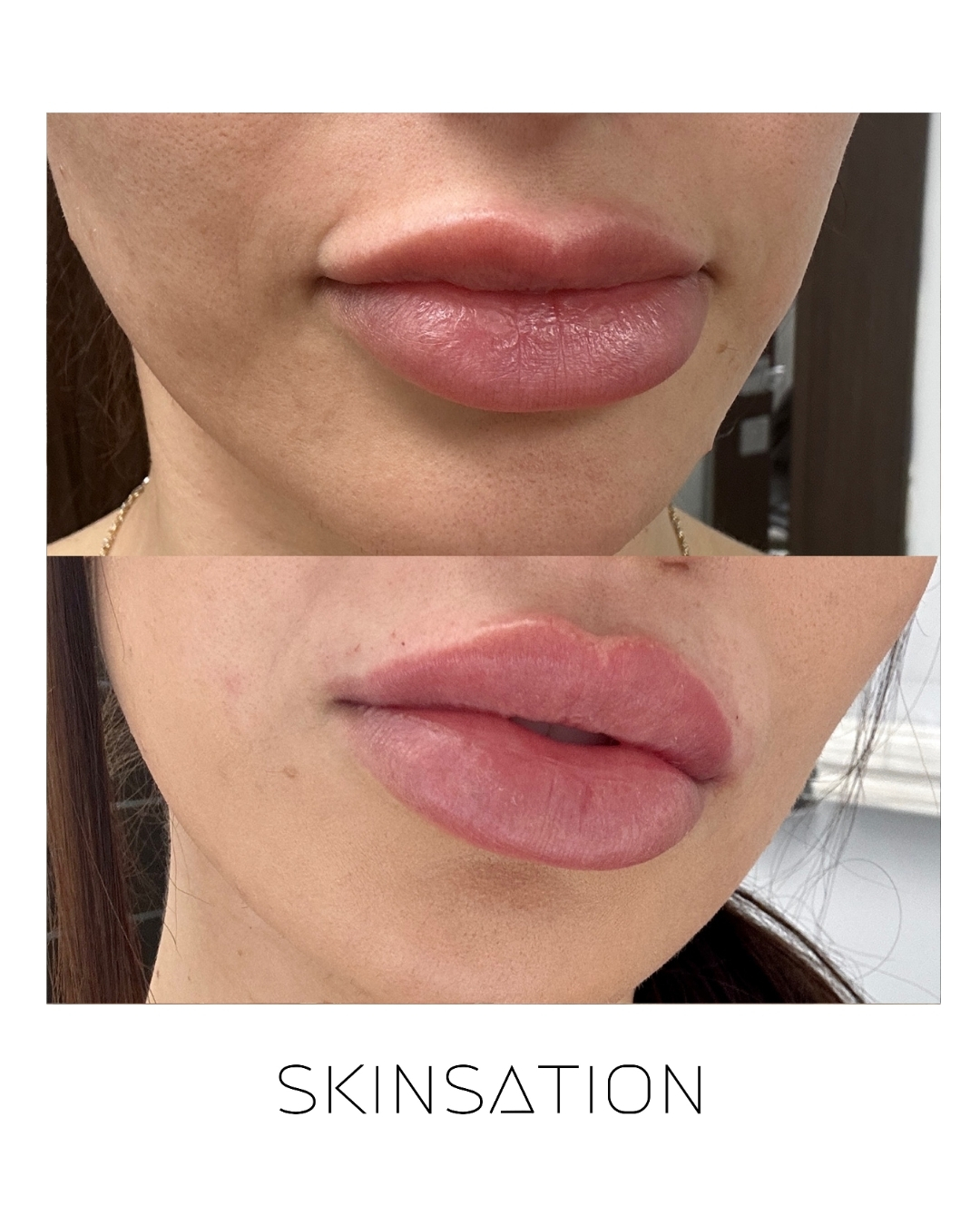 Injectable before and after result 27
