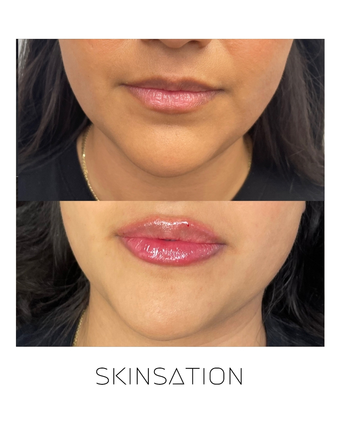 Injectable before and after result 28