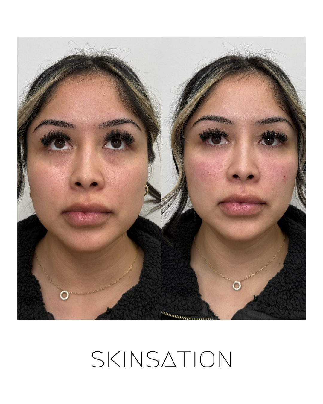 Injectable before and after result 29