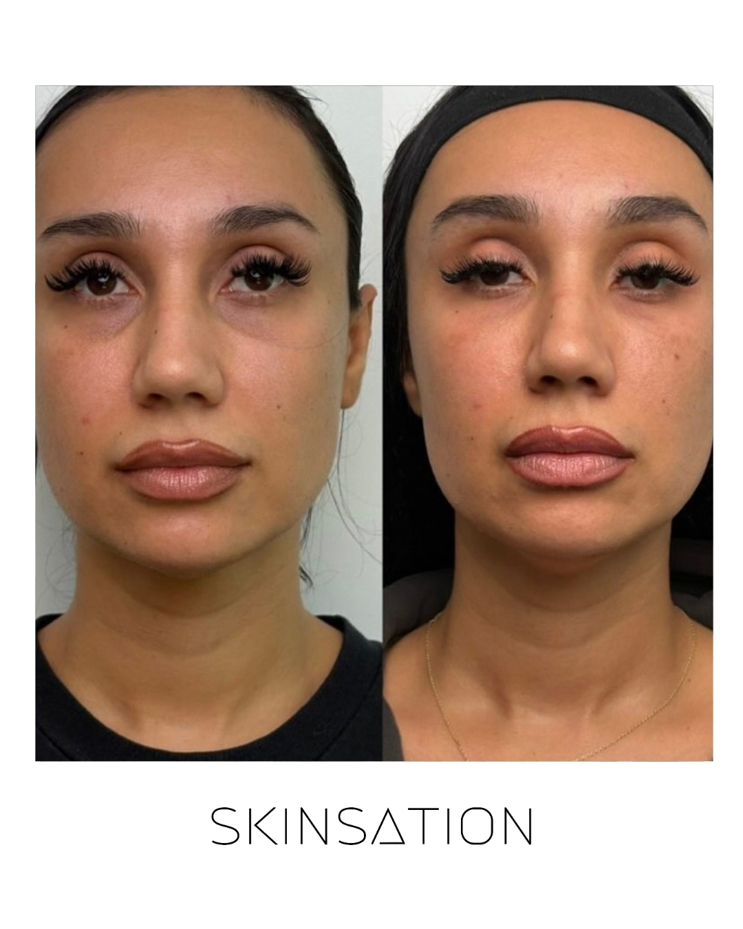 Injectable before and after result 30