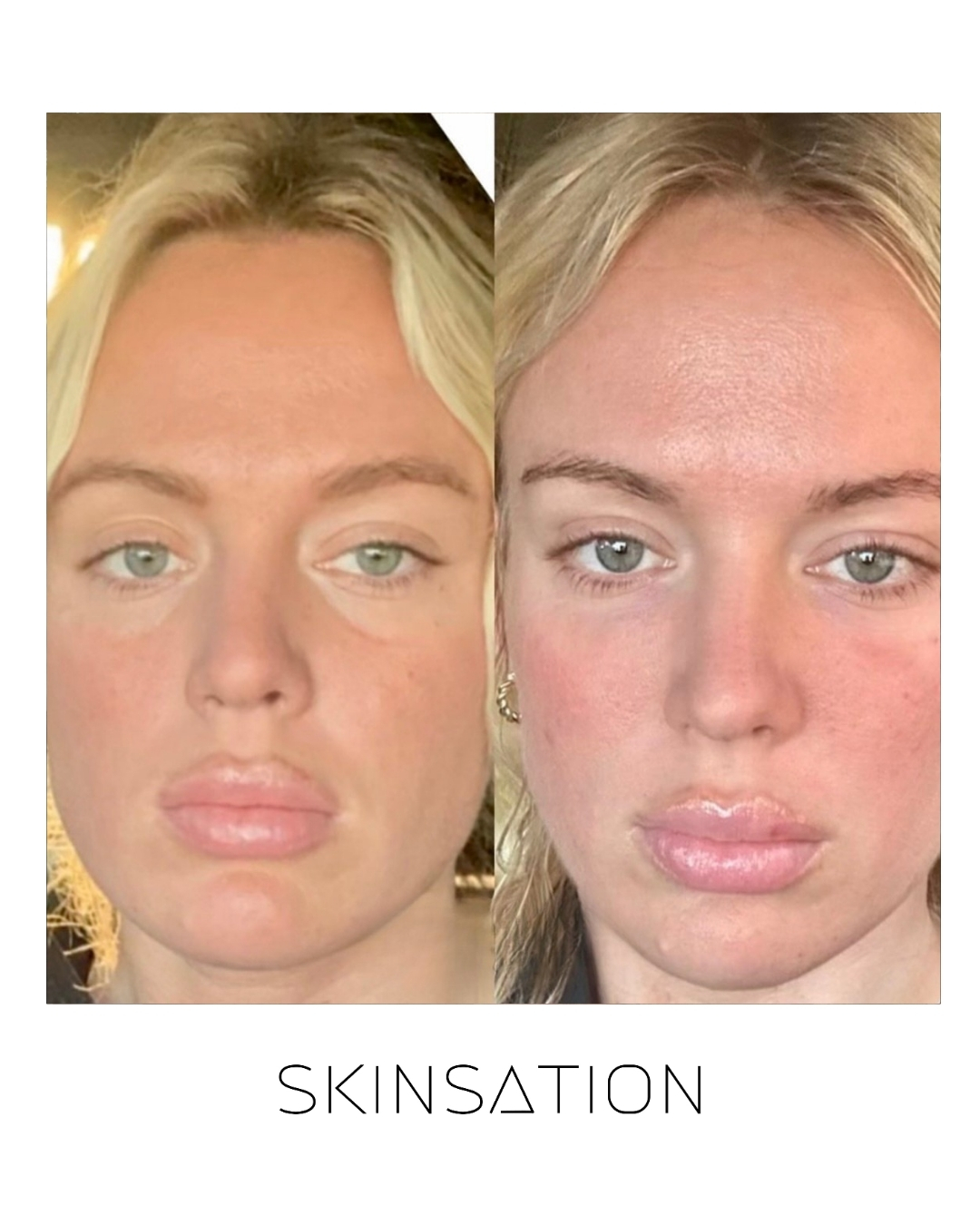 Injectable before and after result 31