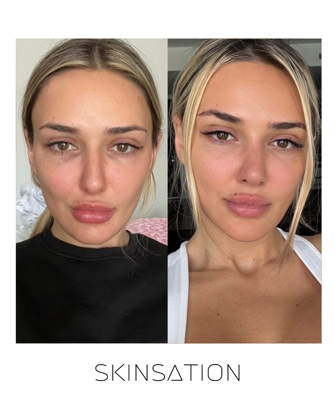 Injectable before and after result 32
