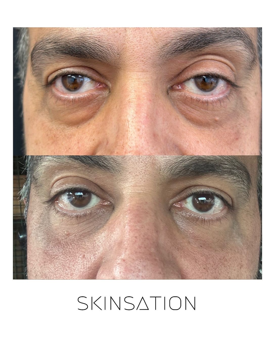 Injectable before and after result 33