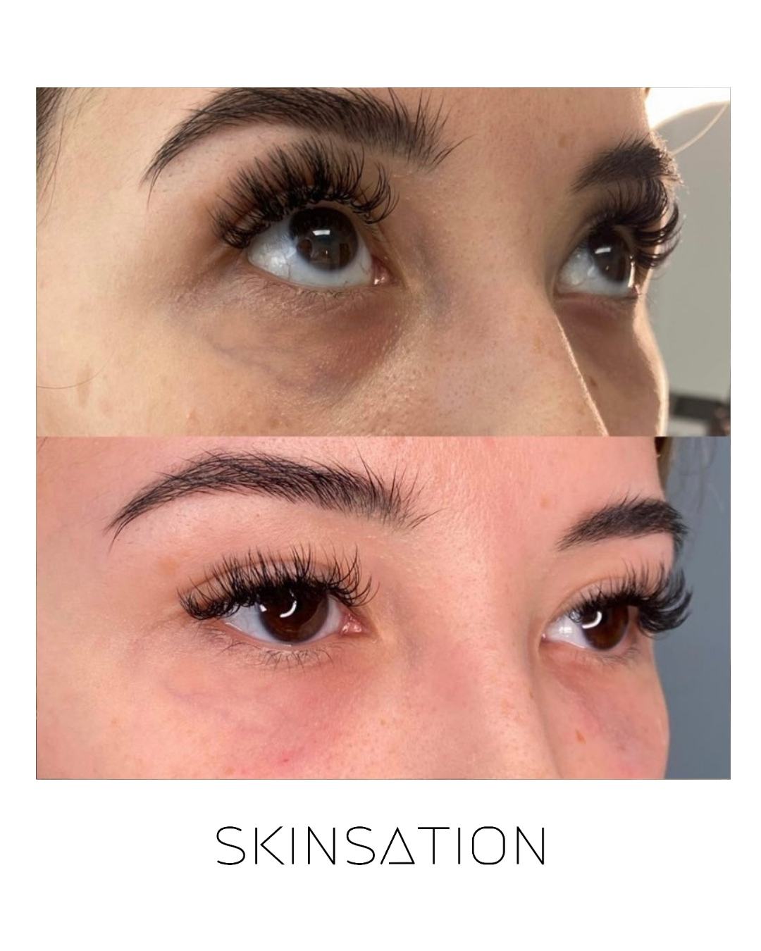 Injectable before and after result 35