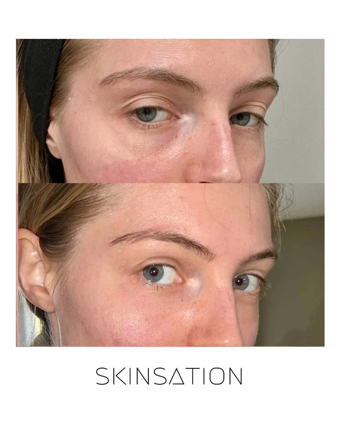 Injectable before and after result 36
