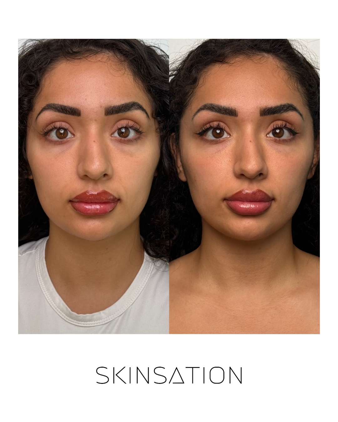 Injectable before and after result 37
