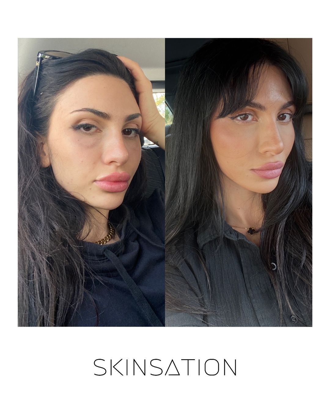 90-day skin transformation program before and after