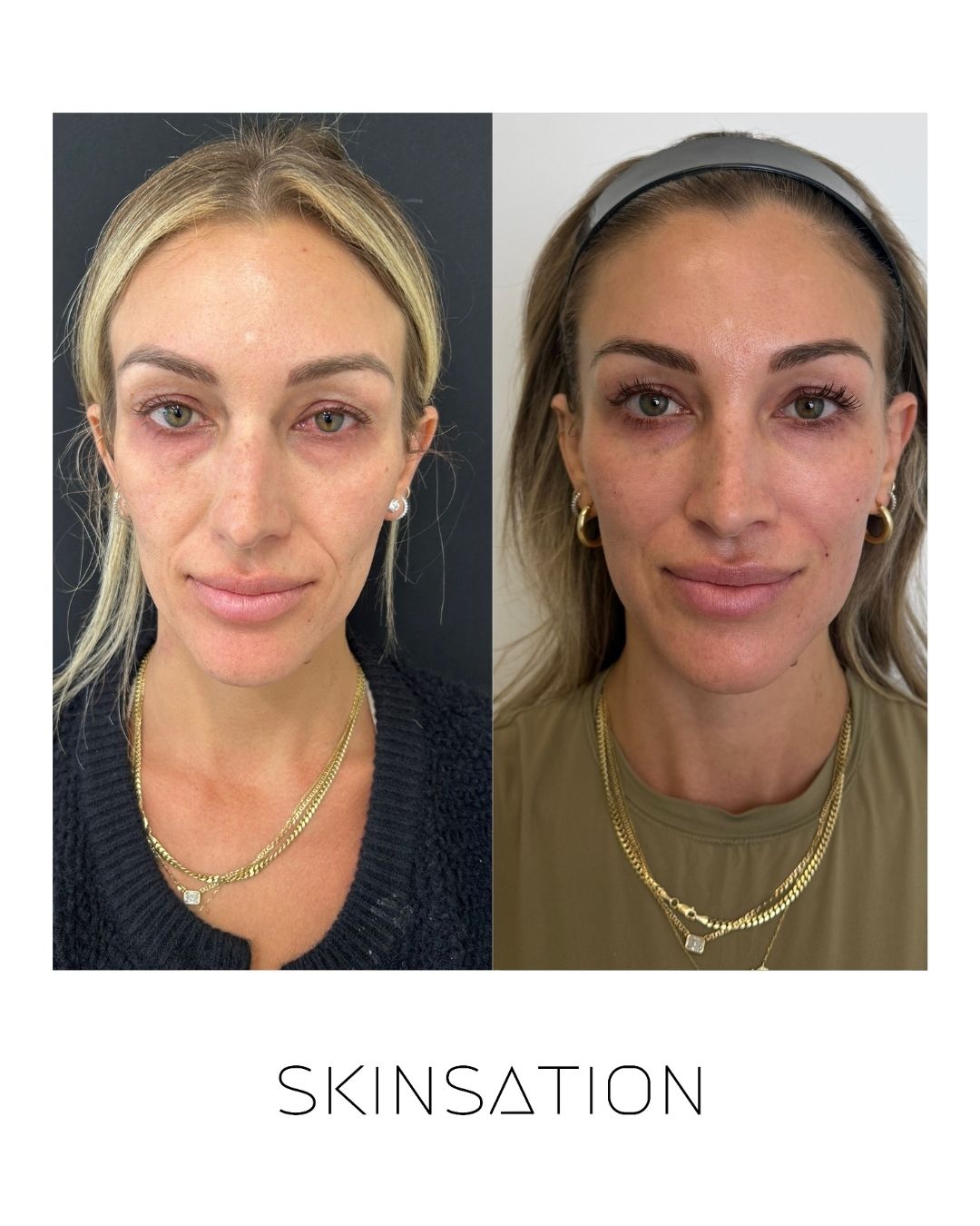 90-day skin transformation facial improvement