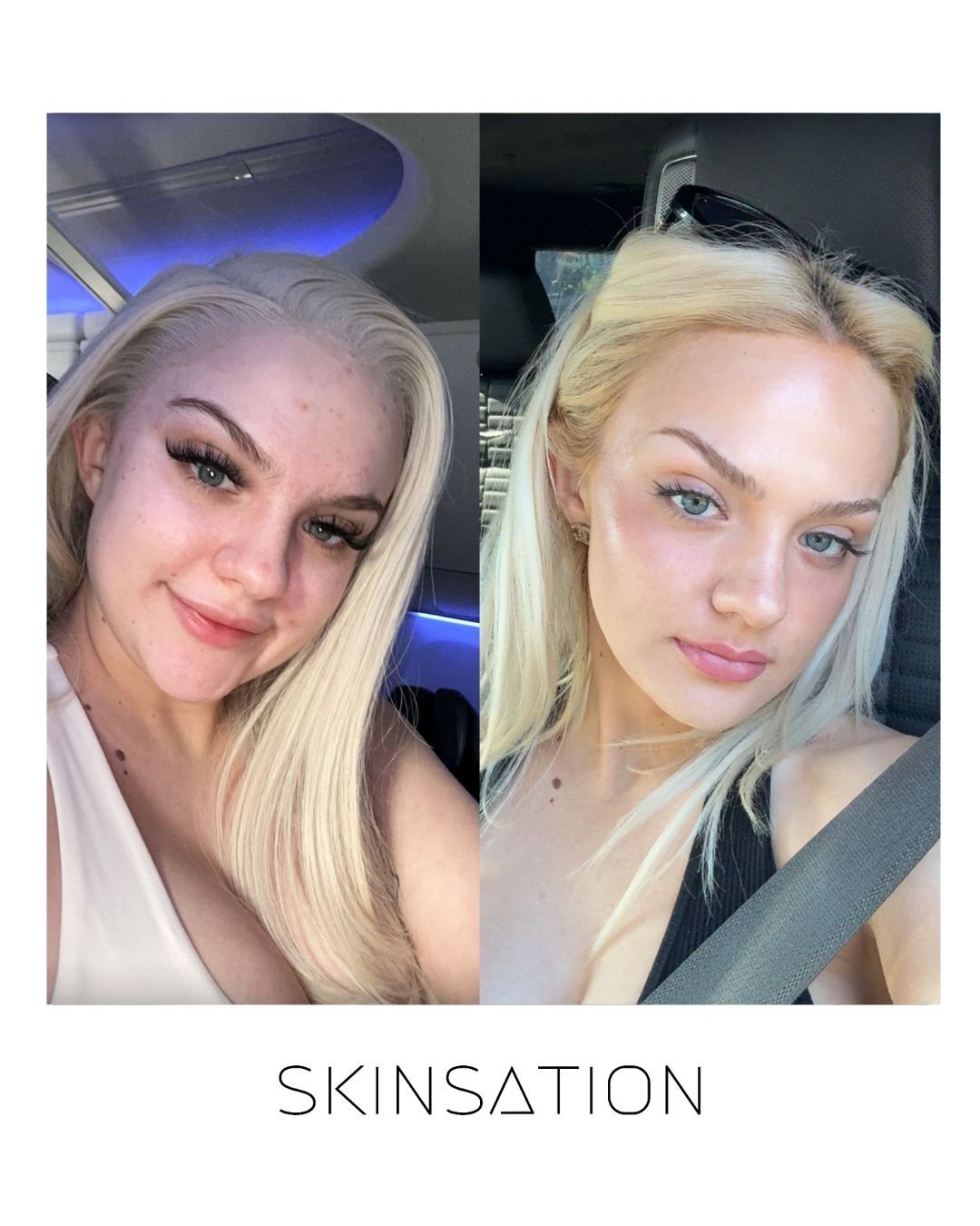 90-day skin transformation acne clearing result