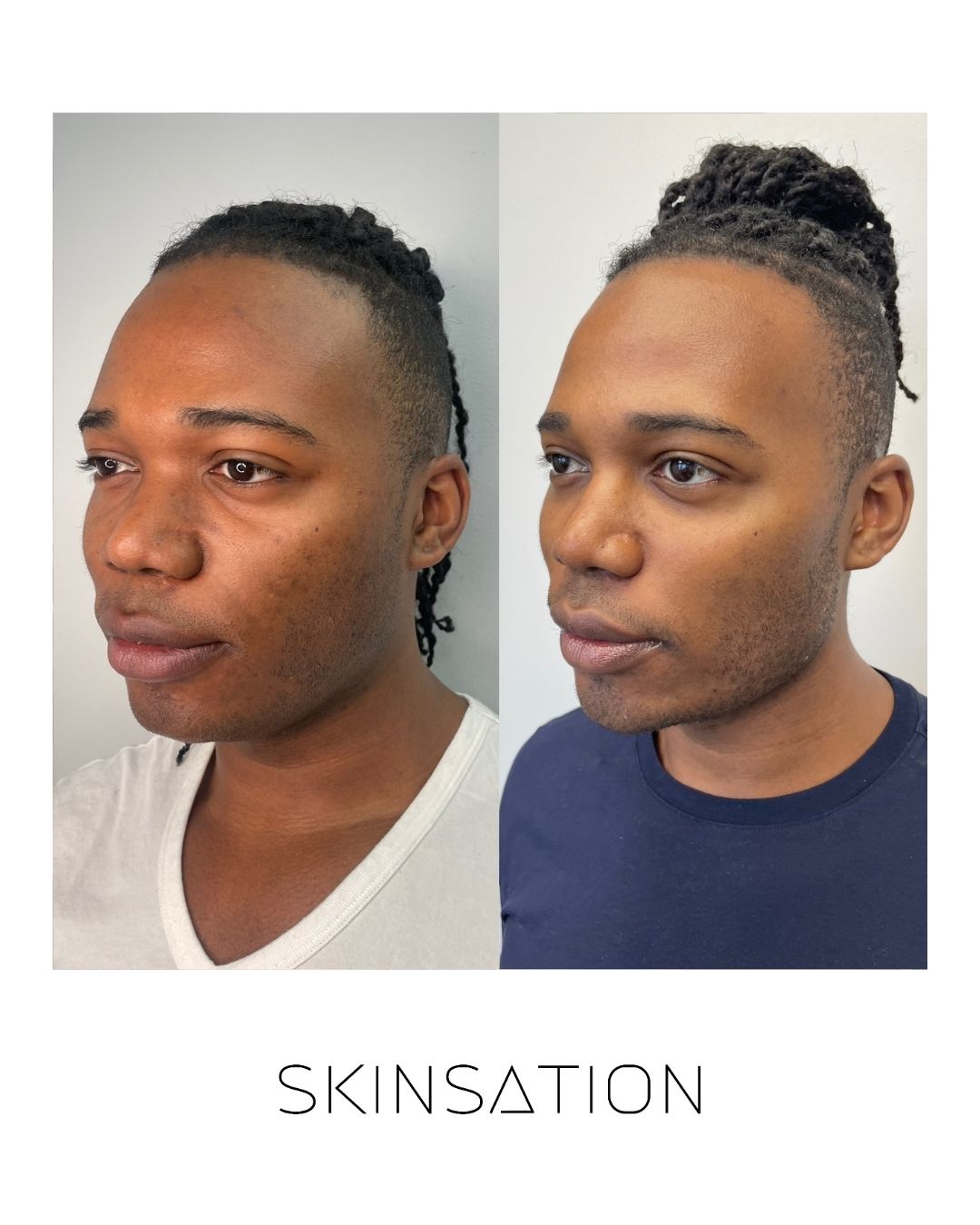 90-day skin transformation texture improvement