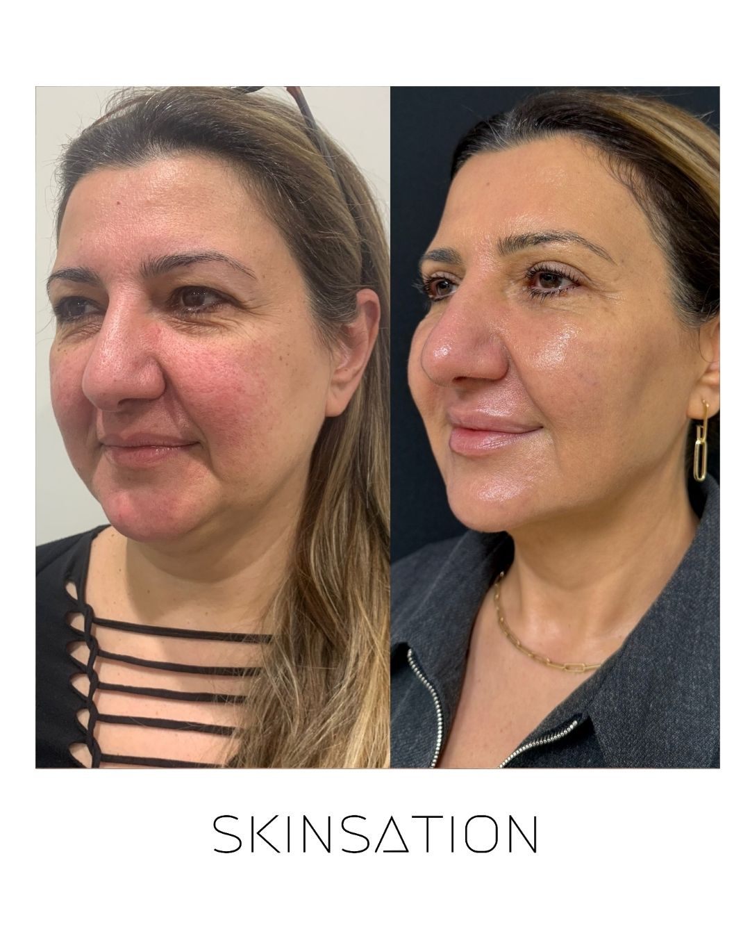 Skin transformation facial rejuvenation result