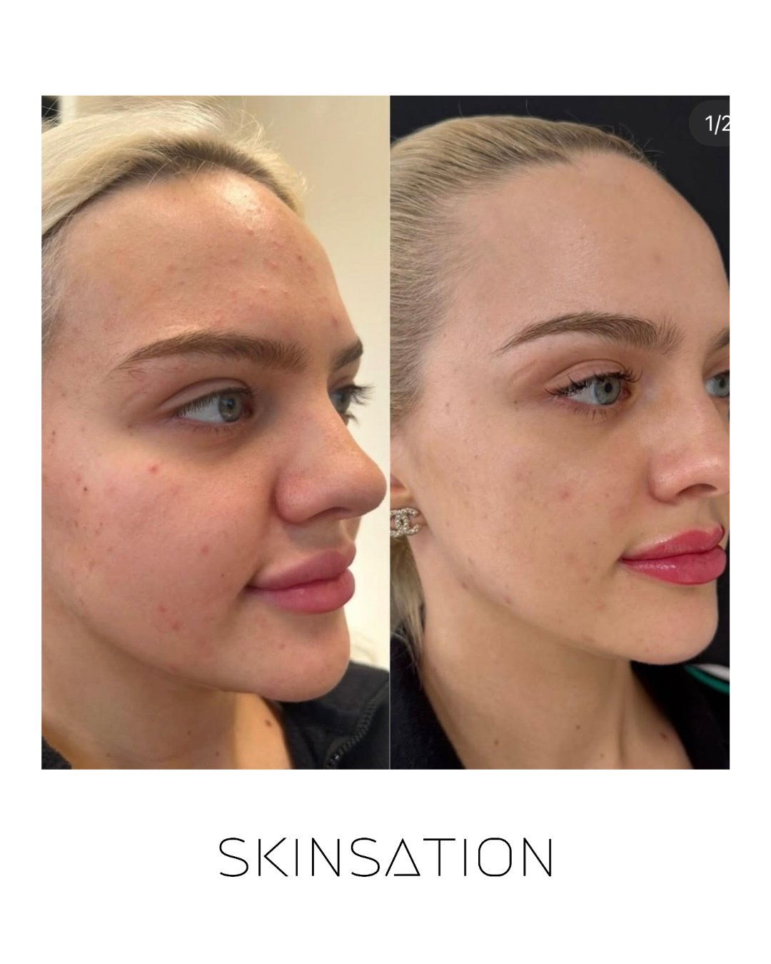 Skin treatment before and after result 1
