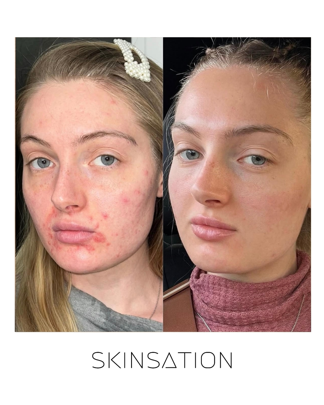 Skin treatment before and after result 2