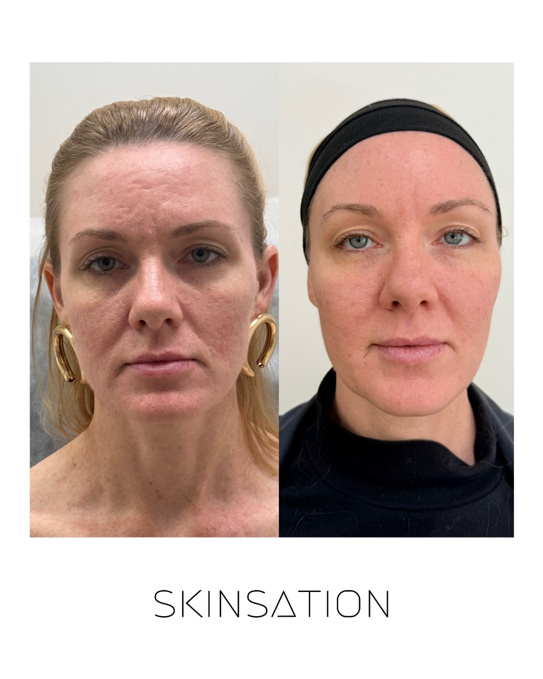 Skin treatment before and after result 3