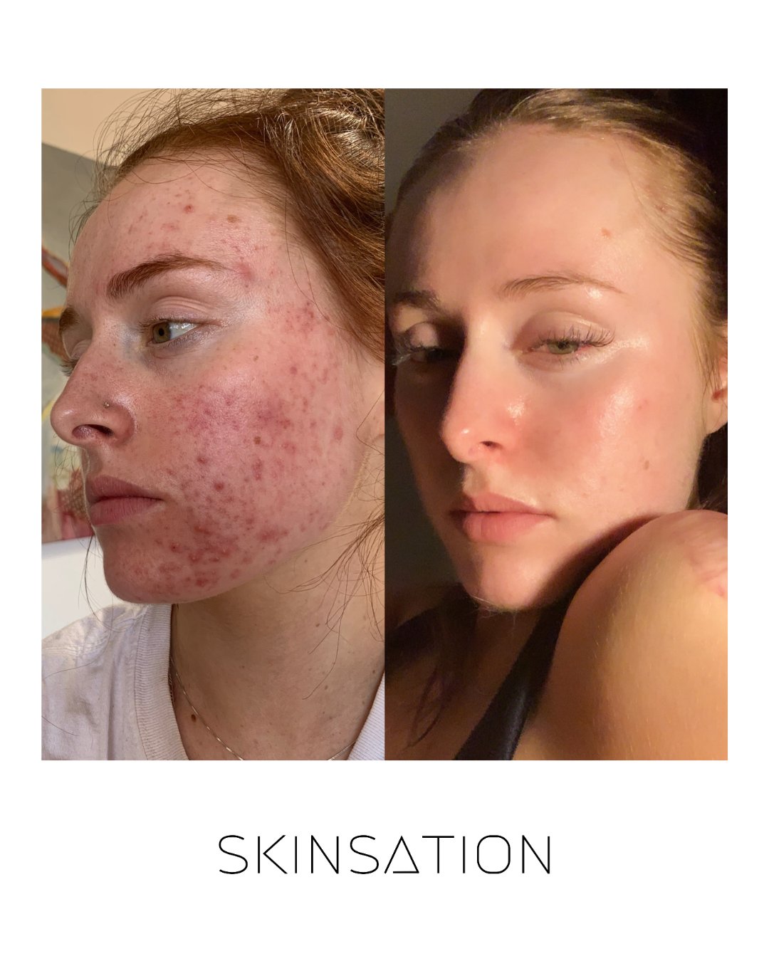 Skin treatment before and after result 4