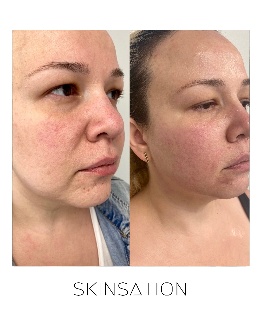 Skin treatment before and after result 5