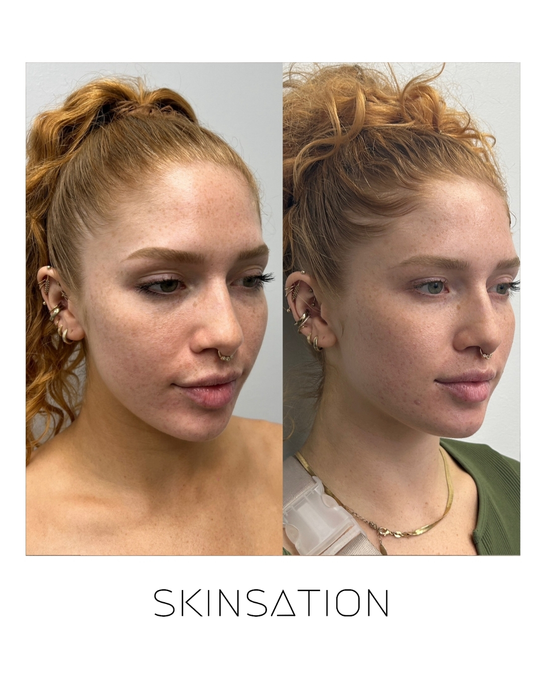 Skin treatment before and after result 7