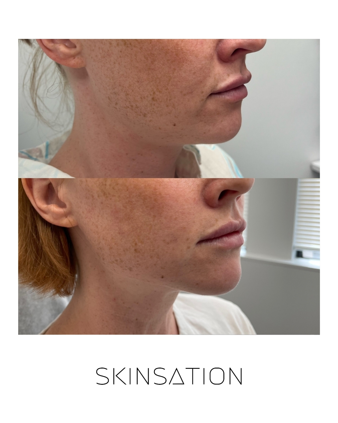 Skin treatment before and after result 8