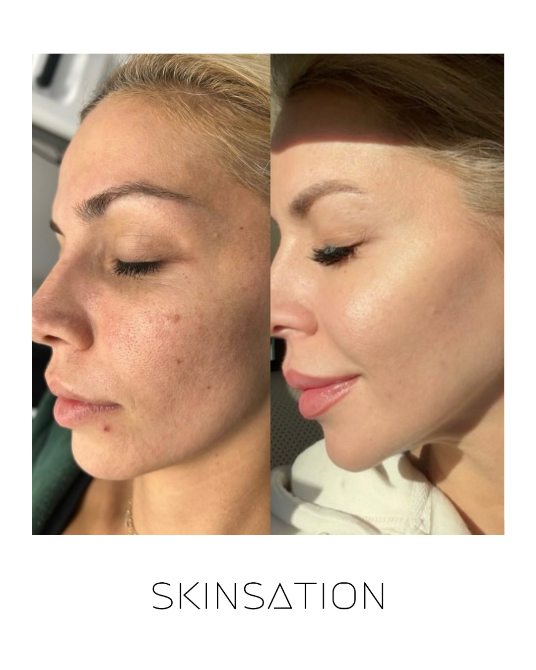 Skin treatment before and after result 9
