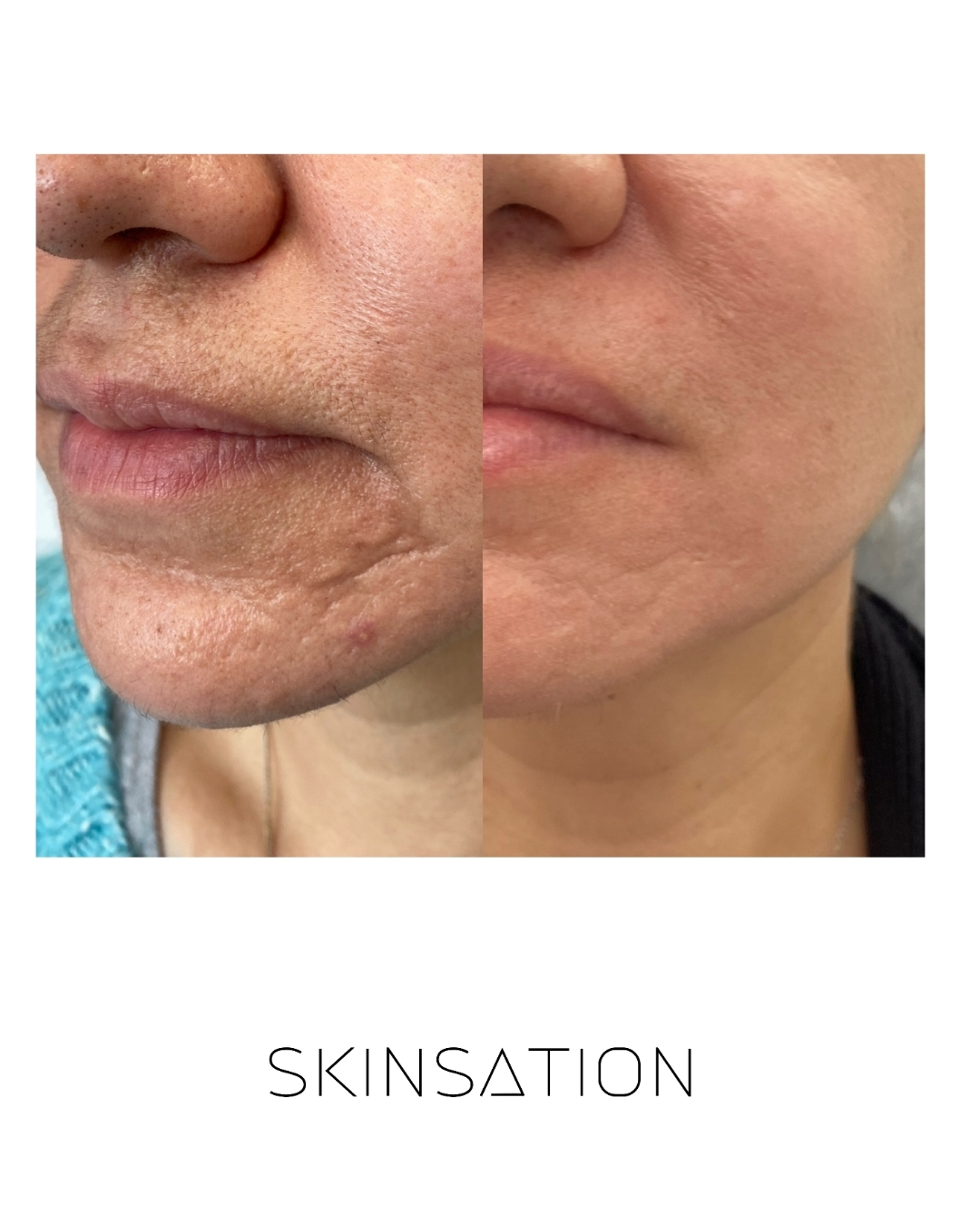 Skin treatment before and after result 10