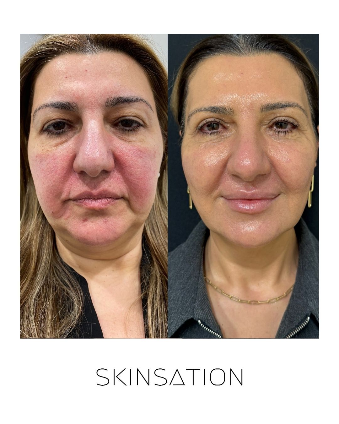 Skin treatment before and after result 11