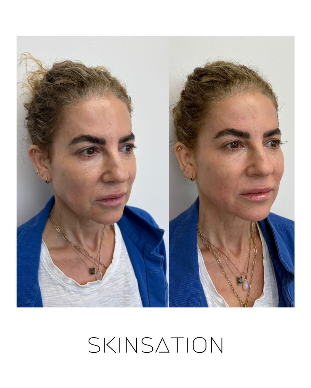 Skin treatment before and after result 13