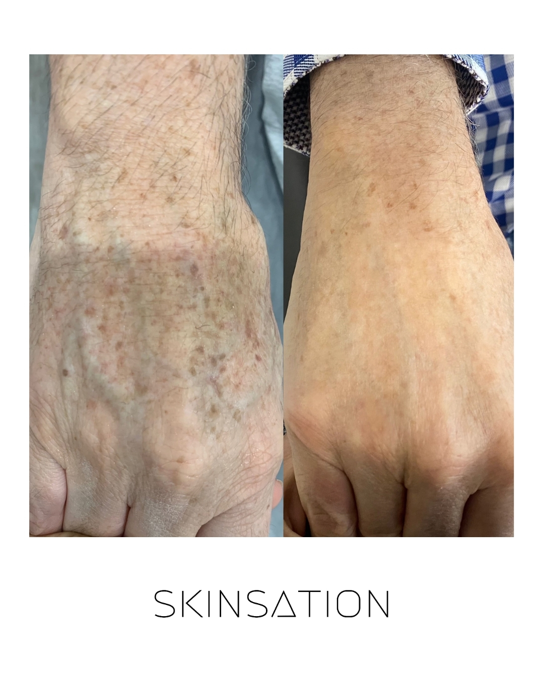 Skin treatment before and after result 14