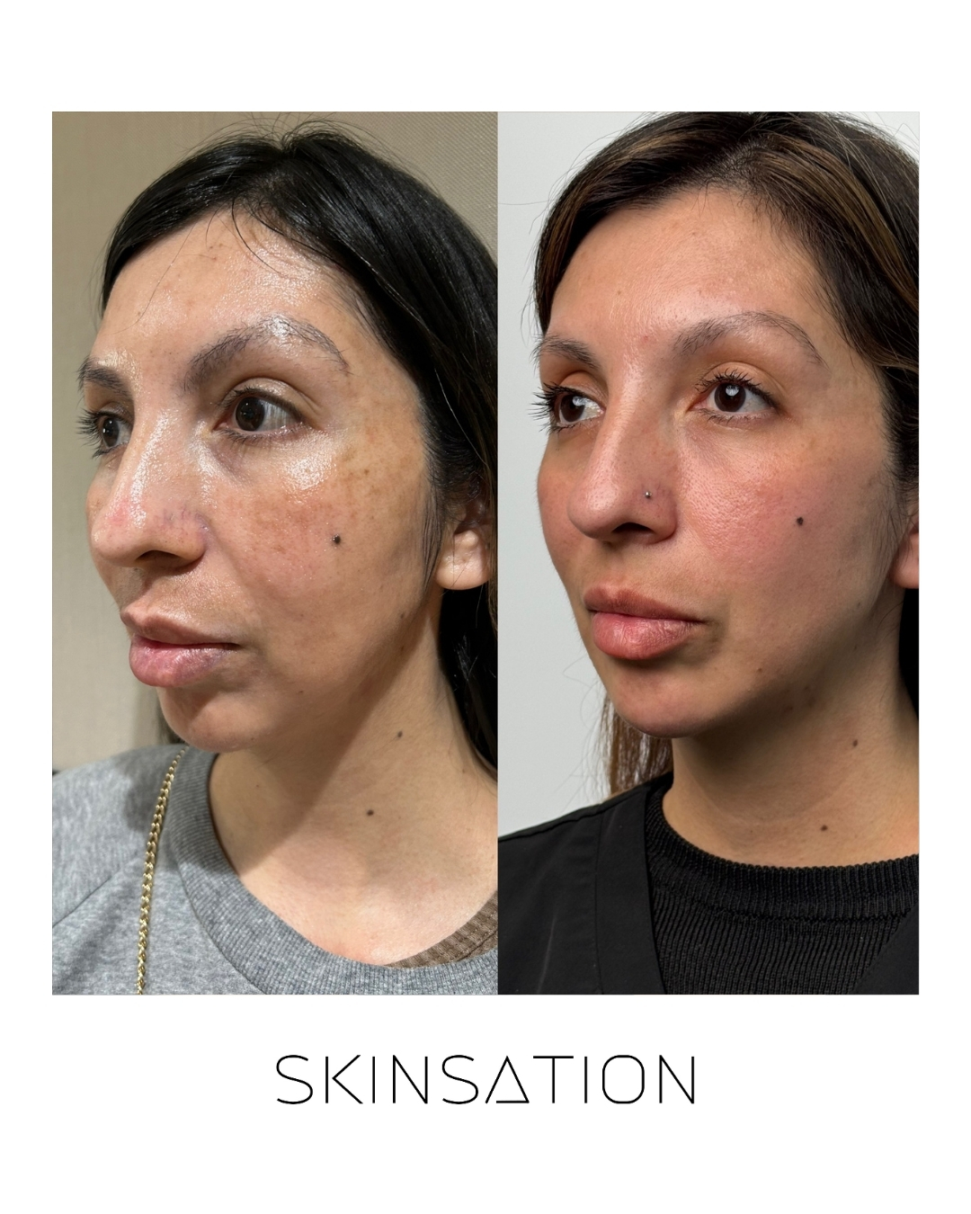 Skin treatment before and after result 15