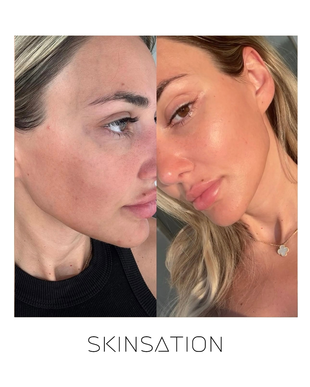 Skin treatment before and after result 16