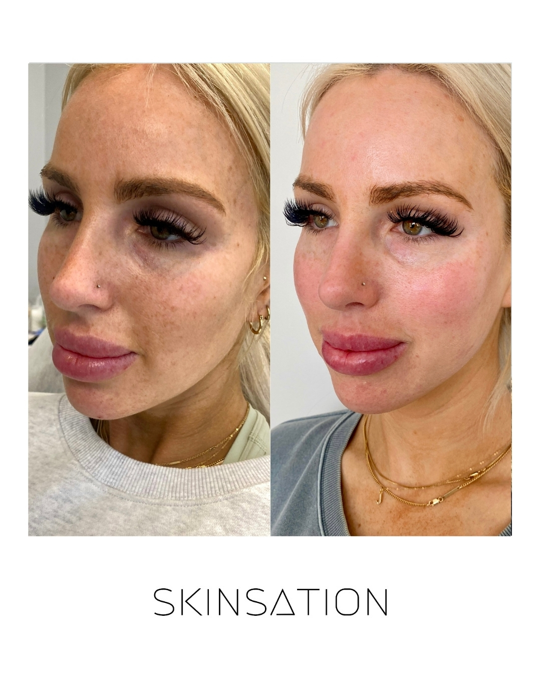 Skin treatment before and after result 17