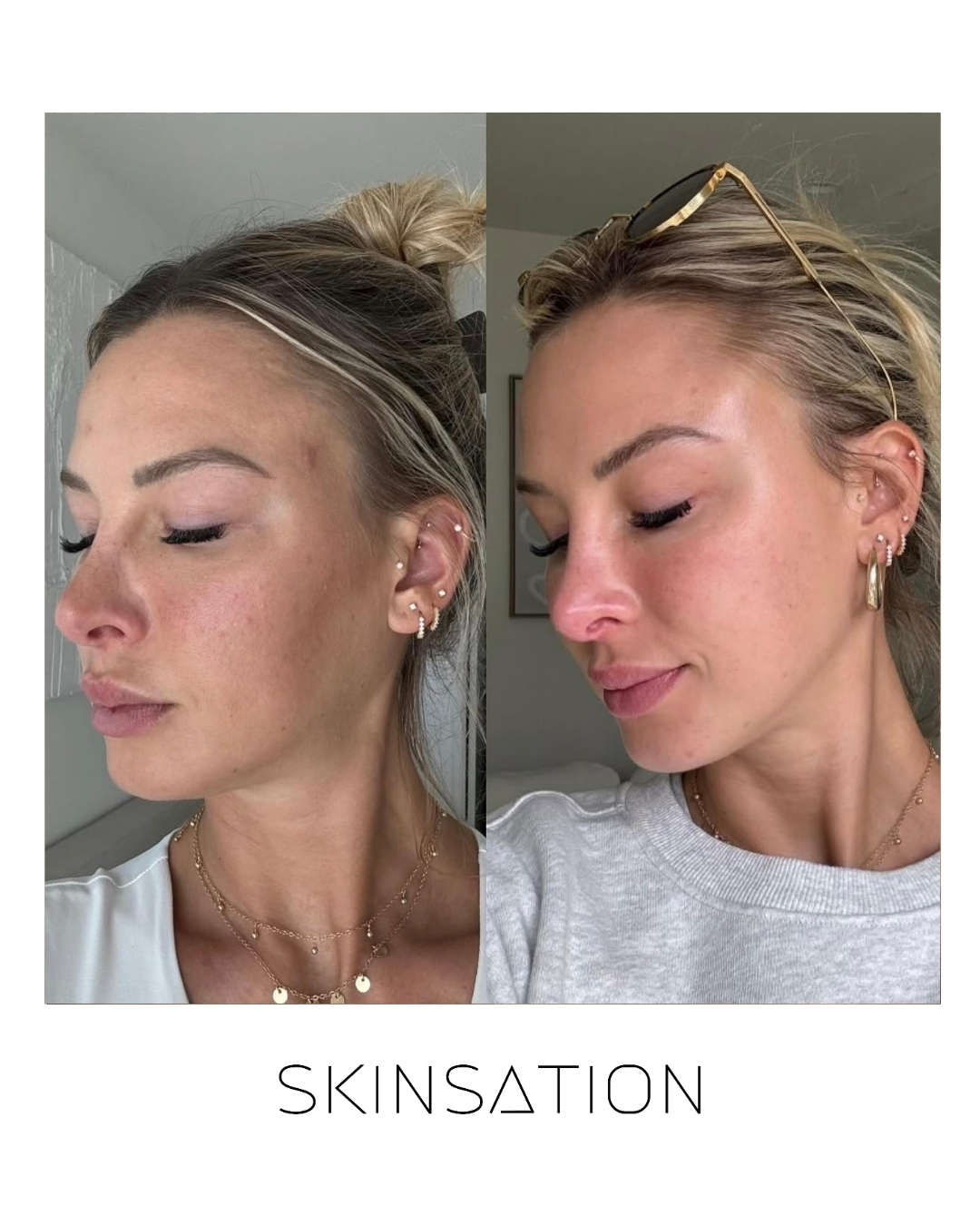 Skin treatment before and after result 18