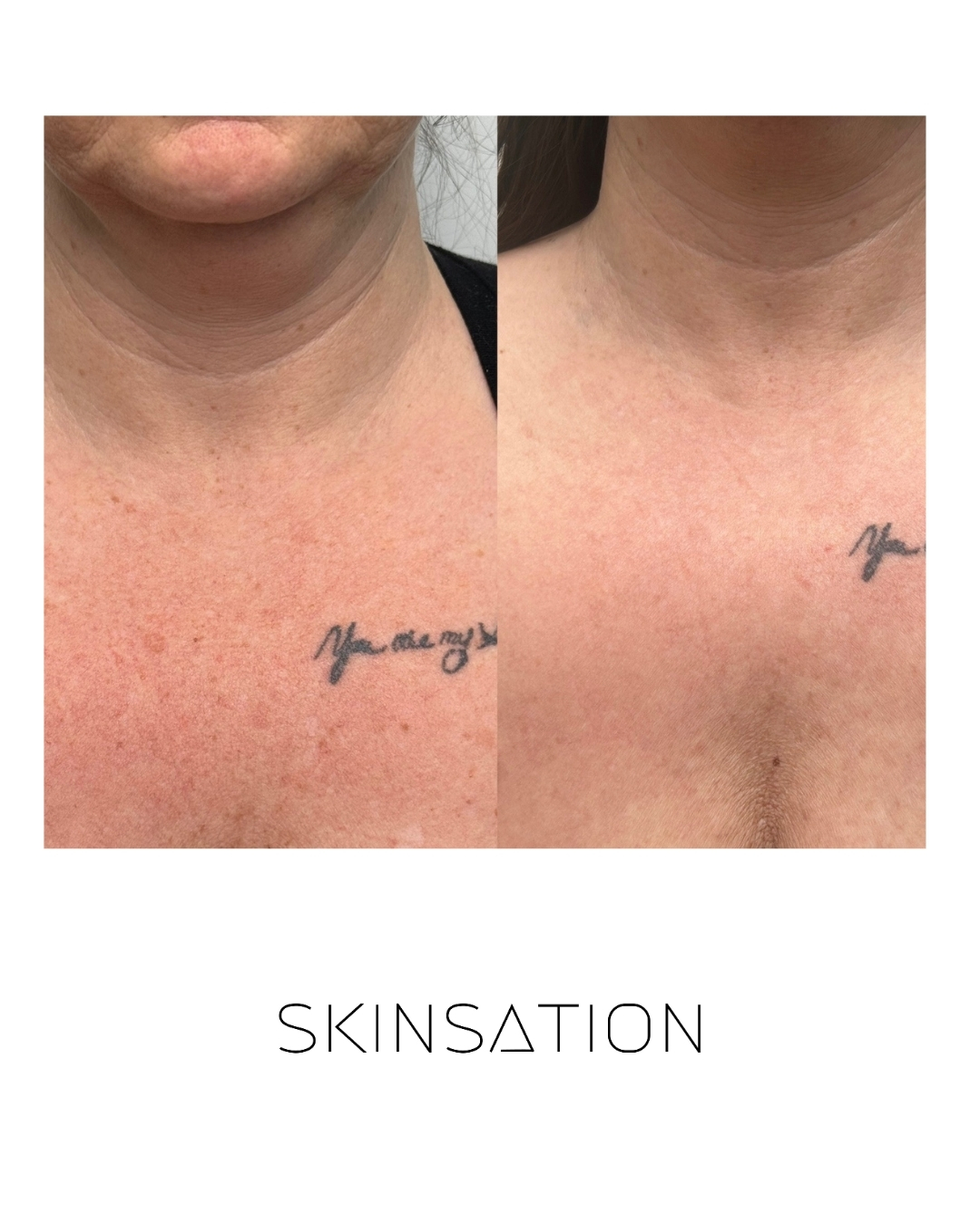 Skin treatment before and after result 19