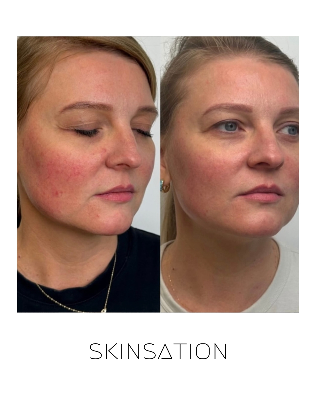 Skin treatment before and after result 21