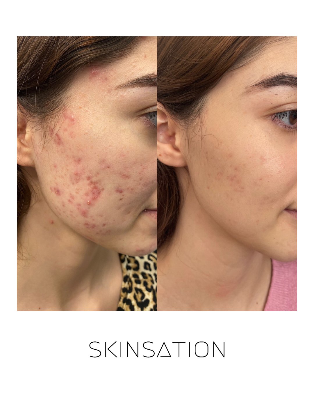 Skin treatment before and after result 22