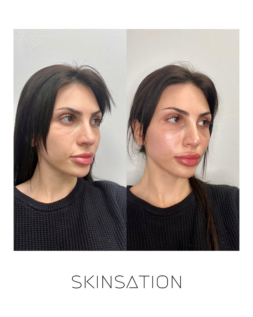 Skin treatment before and after result 23