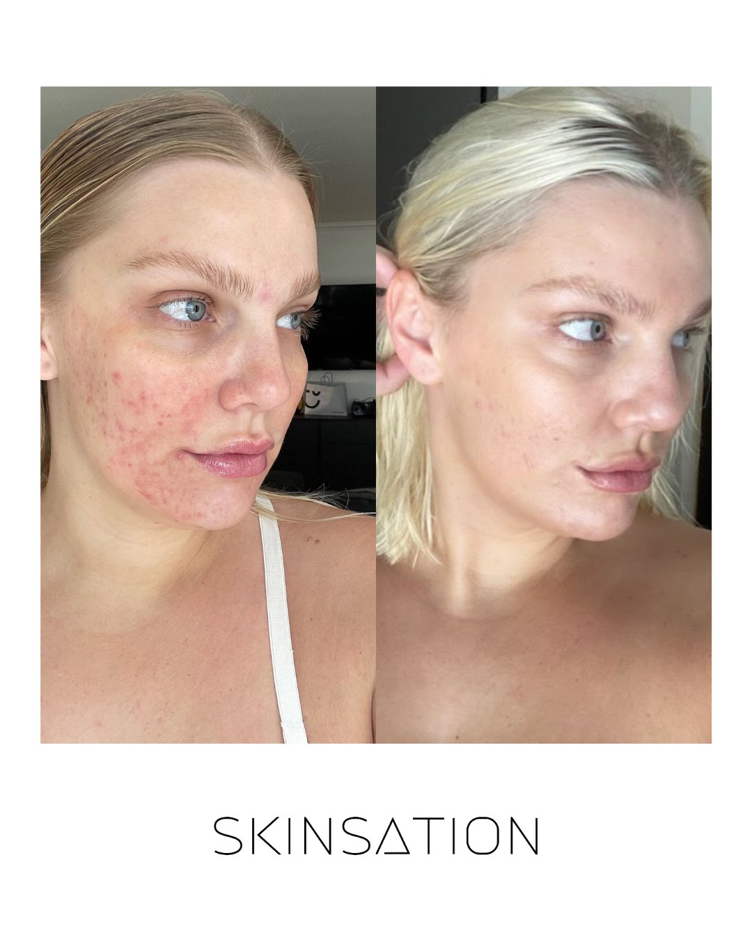 Skin treatment before and after result 24