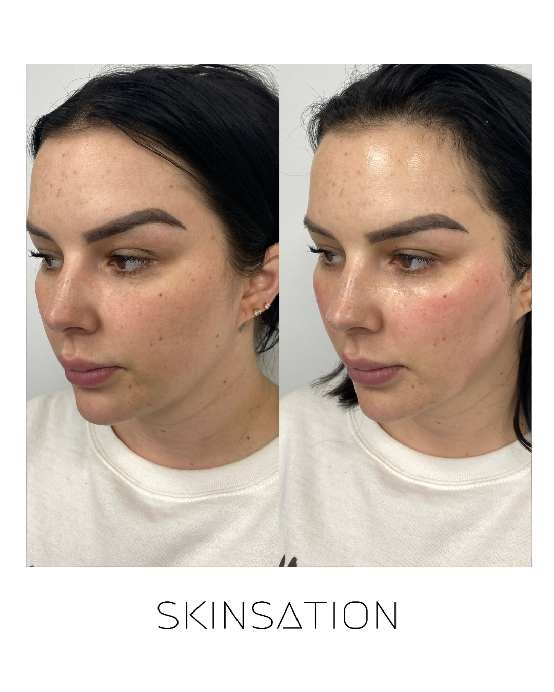 Skin treatment before and after result 25