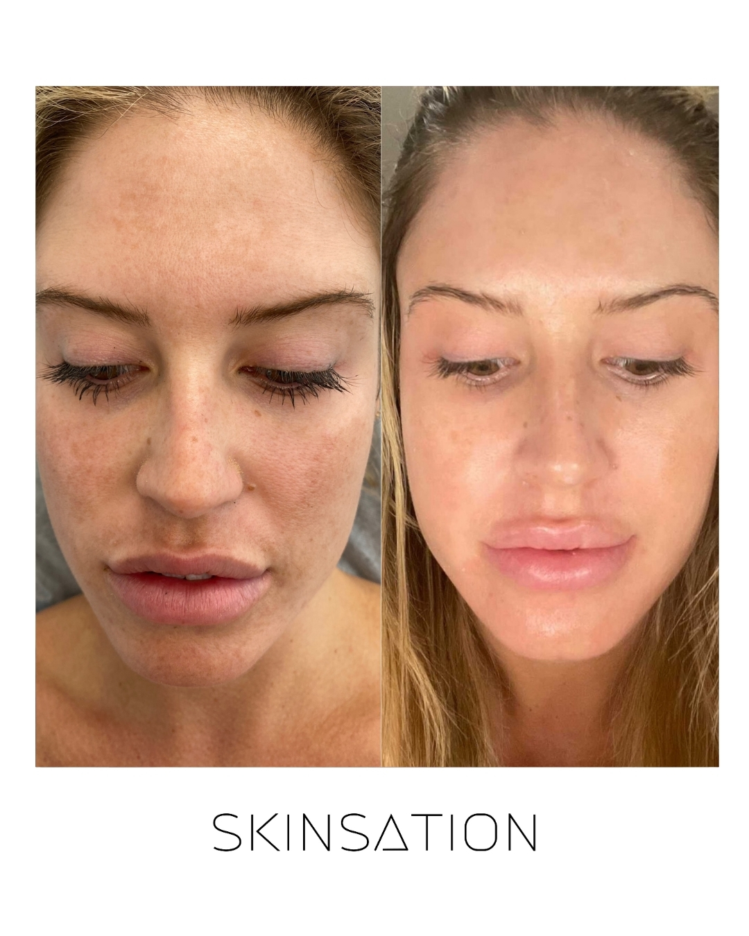 Skin treatment before and after result 26