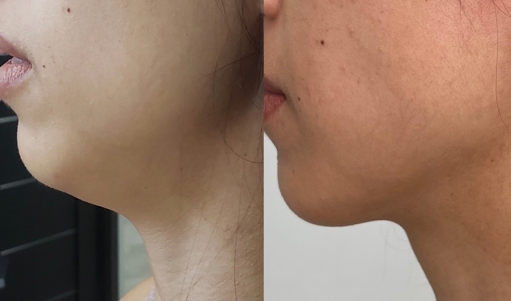Morpheus8 RF microneedling treatment area