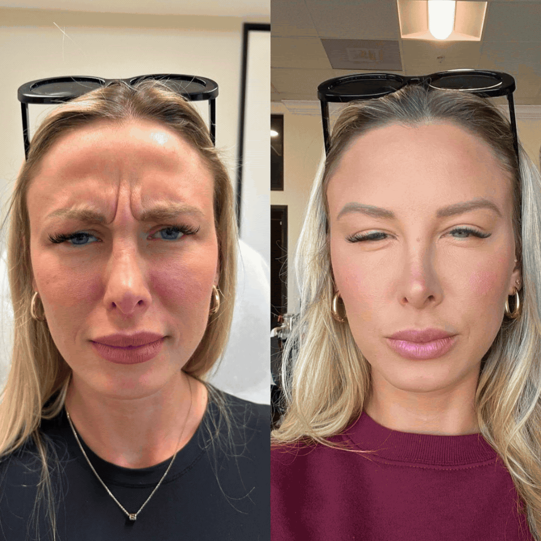 Skinsation LA Botox client montage — real treatment moments