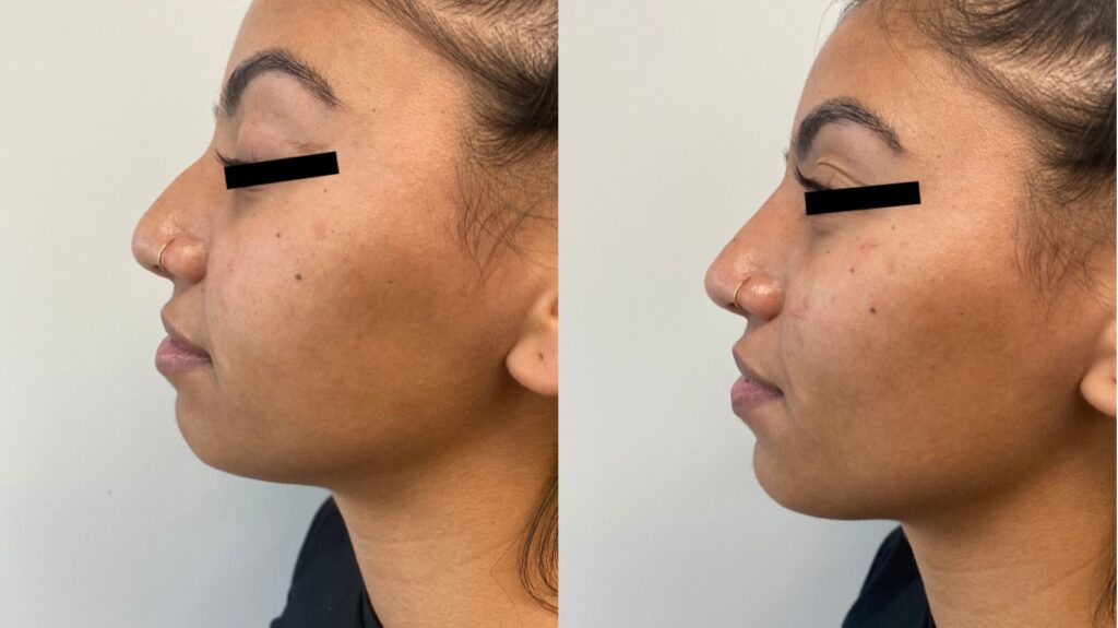 Skinsation LA Instant Forma Facelift