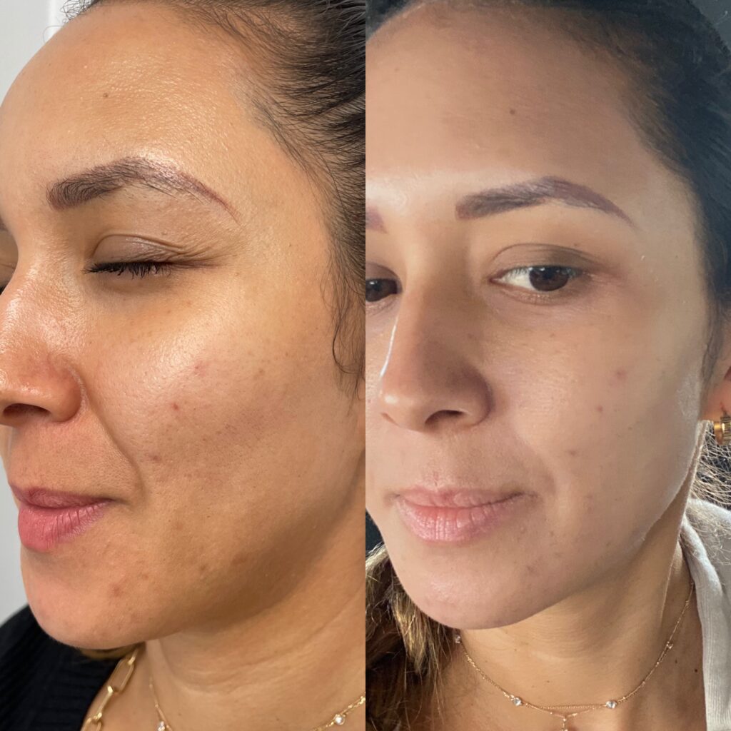 Microdermabrasion with dermaplaing