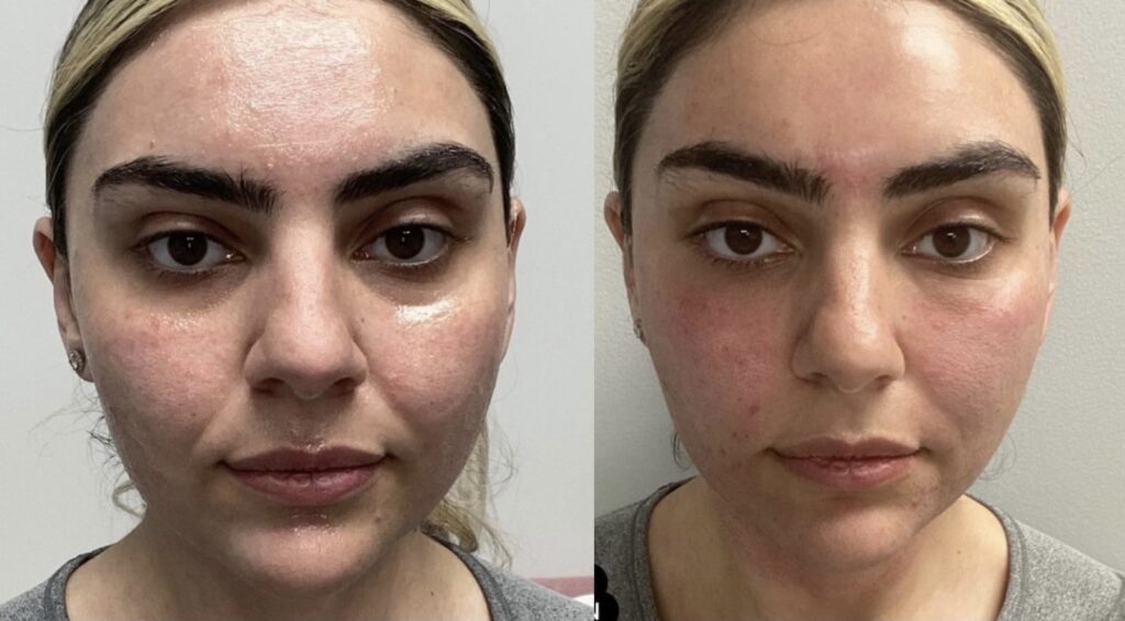 Skinsation LA Morpheus8 and PRP