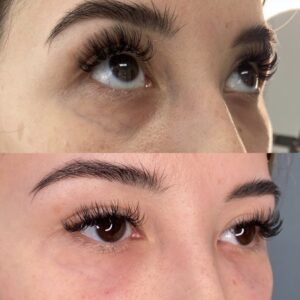 tear troughs before and after