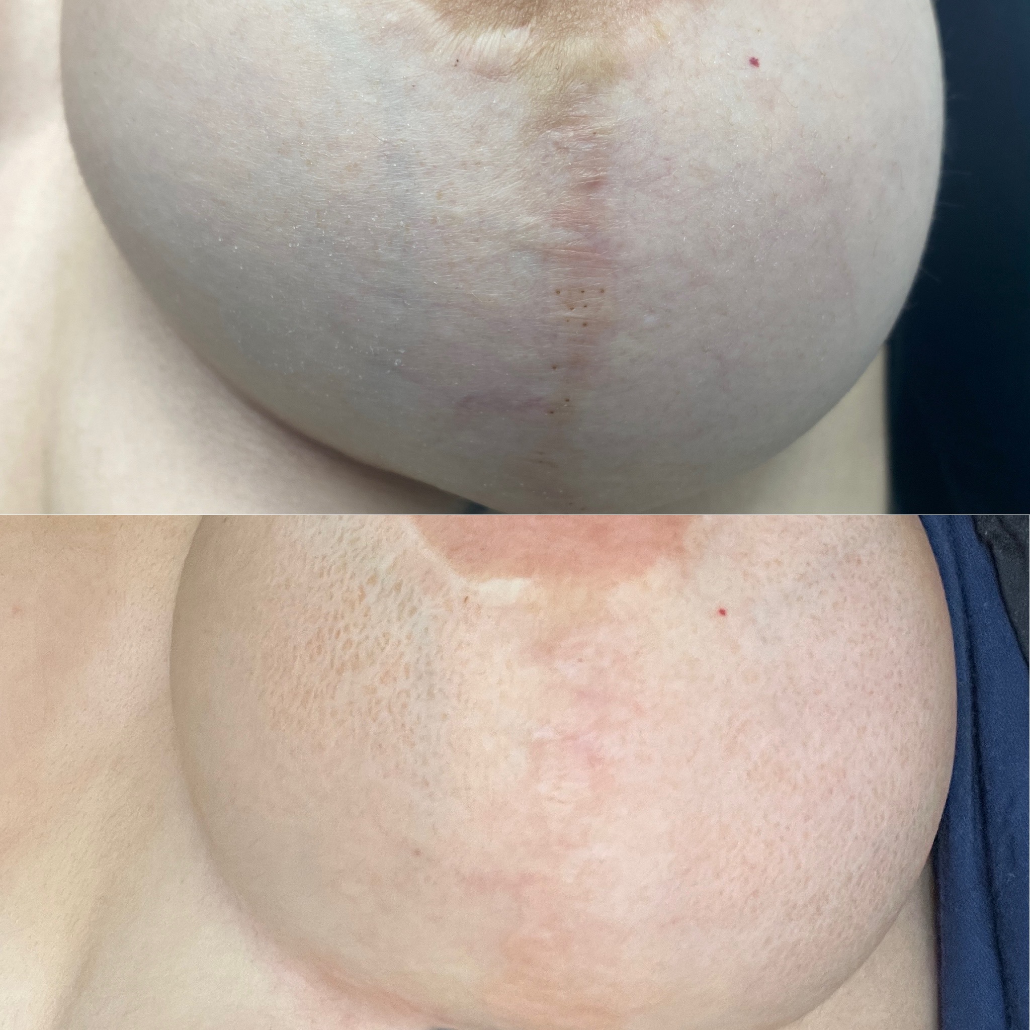 Breast Scar Resurfacing