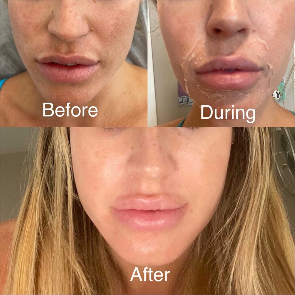 Chemical peel by skinsation la