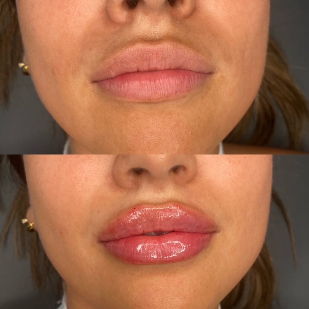 before and after of Lip fillers