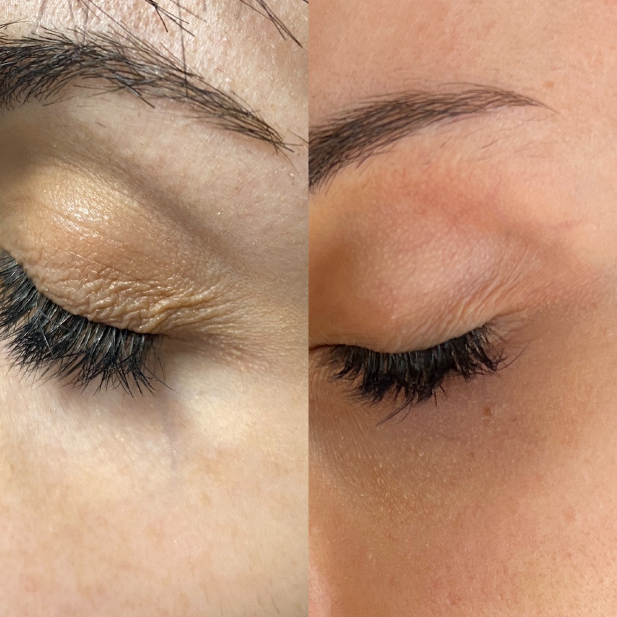 Morpheu8 for eyelid skin tightening